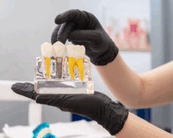 Dental Implant Process