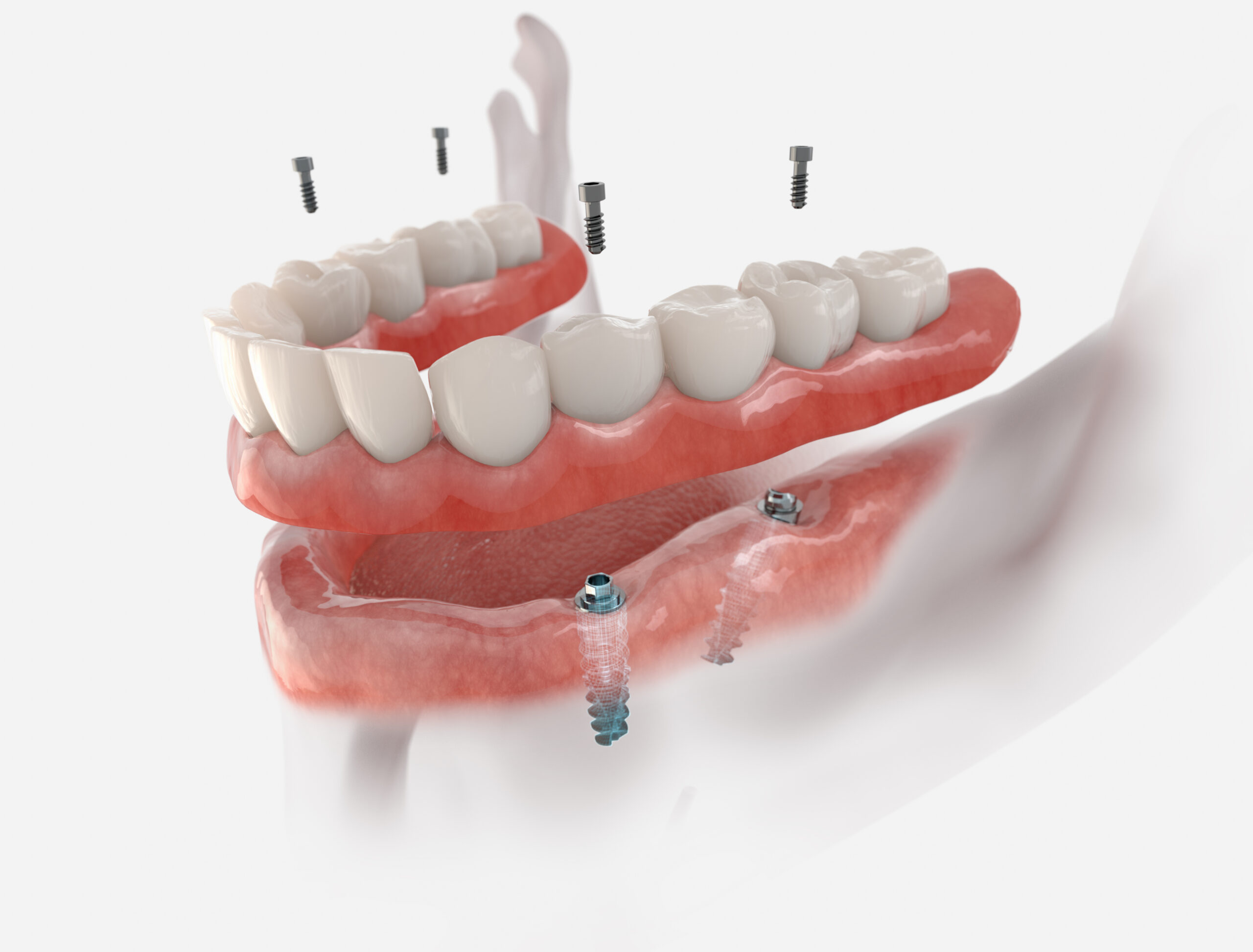 Snap-On Implant Denture