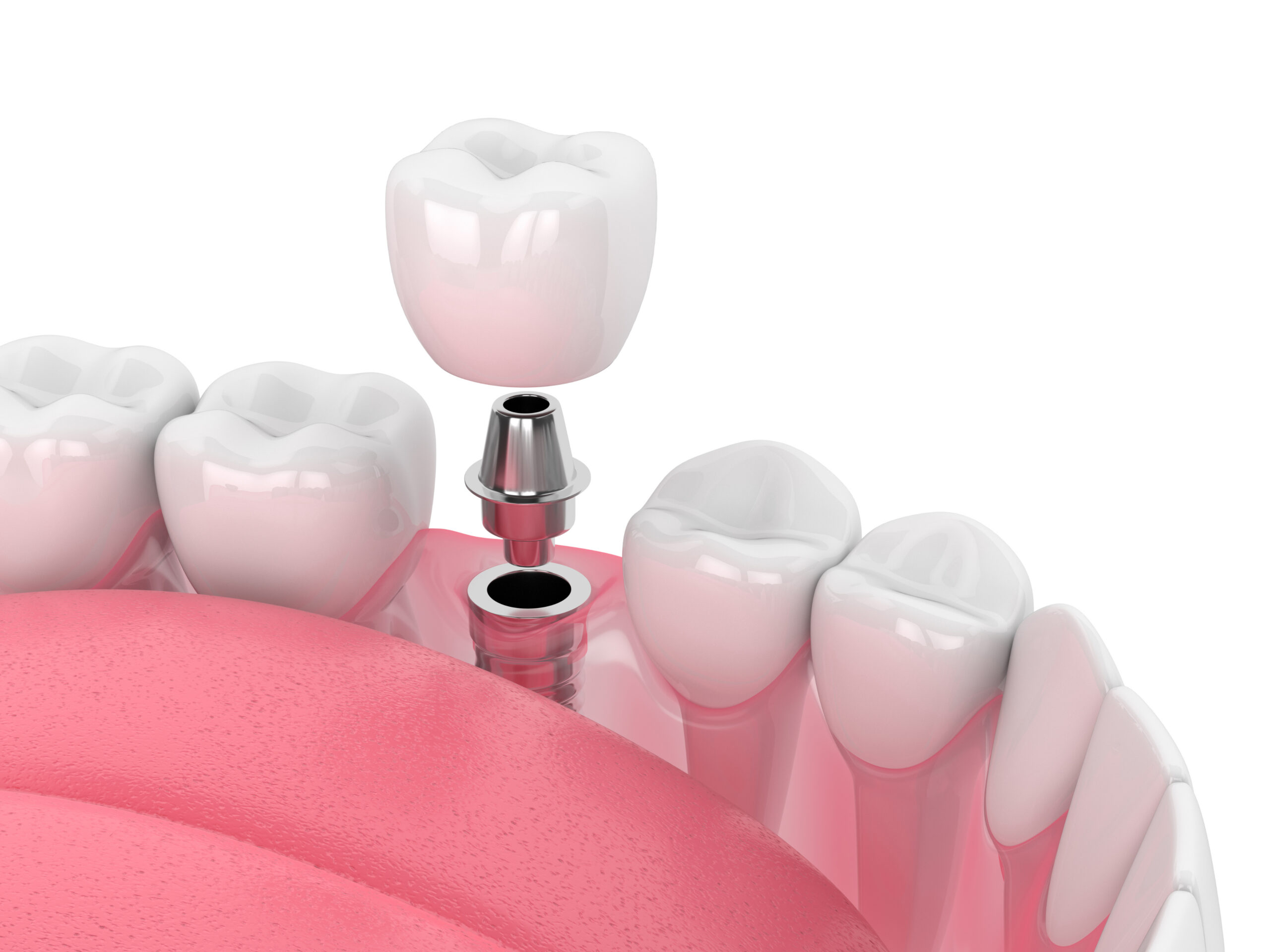 Single Dental Implant